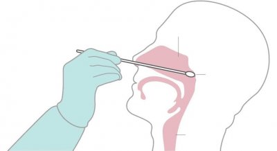 ​鼻咽拭子和口咽拭子哪个痛苦小（为何少数患者鼻咽拭子多次阴性）