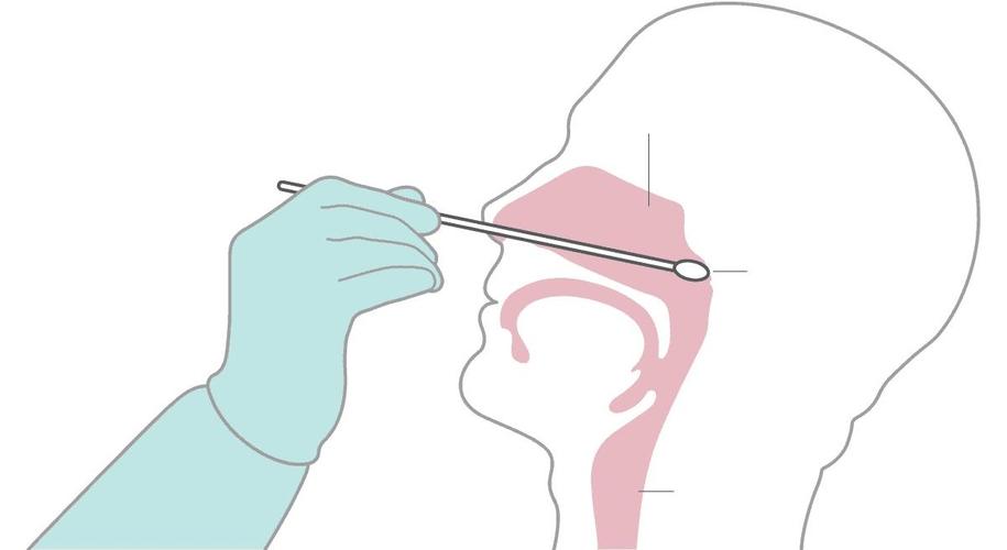 鼻咽拭子和口咽拭子哪个痛苦小(为何少数患者鼻咽拭子多次阴性)