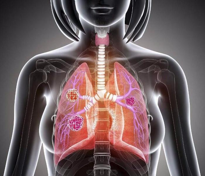 晚期肺癌骨转移，医生说最多活6个月，但她现在已经活了15年！