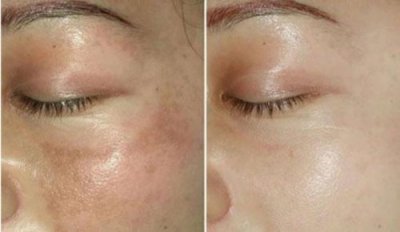 ​黄褐斑的去除小偏方(黄褐斑的去除小方法)