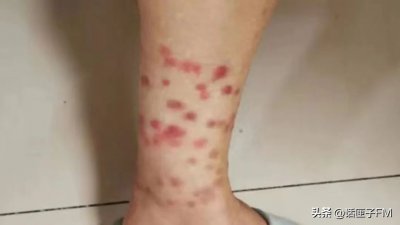 ​要命了！小区跳蚤泛滥，居民满腿大红包，罪魁祸首居然是TA！