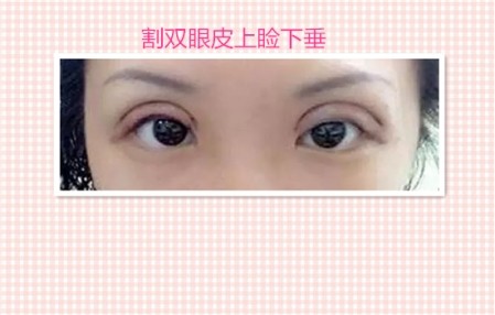 这些都是割双眼皮失败案例图片，看完你还敢割双眼皮吗？