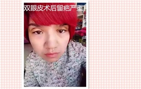这些都是割双眼皮失败案例图片，看完你还敢割双眼皮吗？