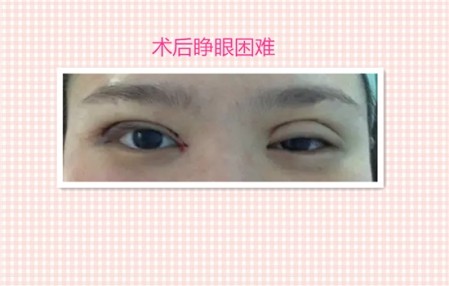 这些都是割双眼皮失败案例图片，看完你还敢割双眼皮吗？