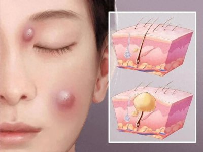 ​科普|不是痘痘，是多发的皮脂腺囊肿